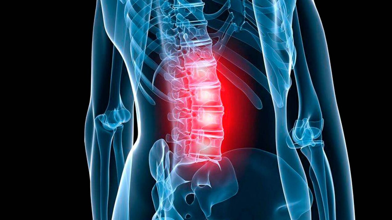 Symptoms of lumbar spondylosis