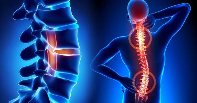 pain localization in osteoarthritis