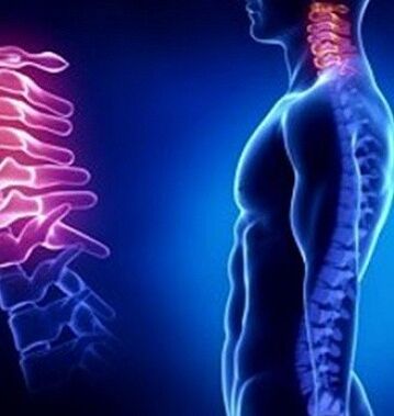 Cervical osteonecrosis can be caused by neck trauma