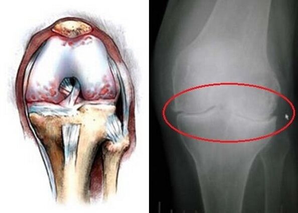 Degenerative Knee
